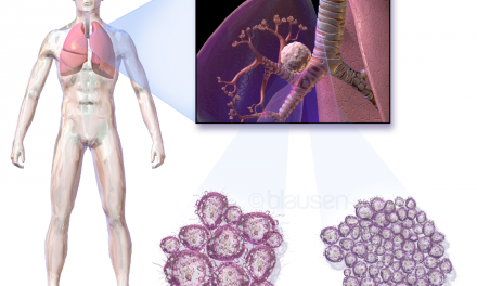 Anticorpi che attaccano il tumore: il successo di Keytruda